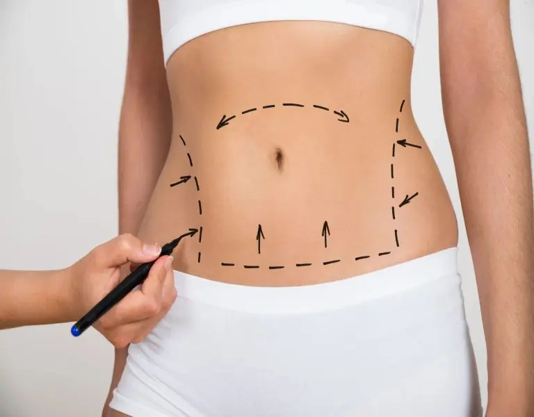 Here's an alt tag for the image: Liposuction markings on abdomen.